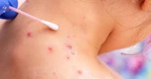 روسيا تختبر لقاحا جديدا ضد الجدري